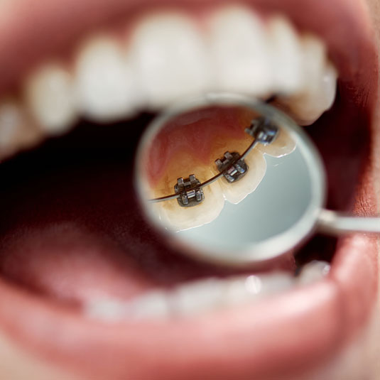  How much do lingual braces cost in Melbourne?