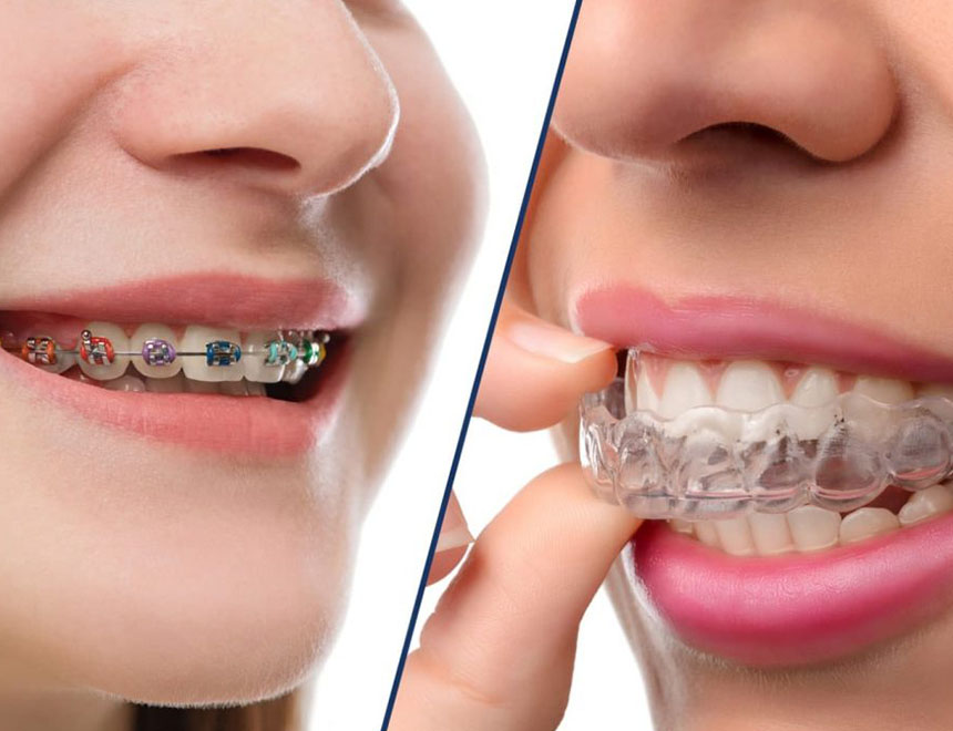 Is Invisalign® Cheaper Than Braces in Australia? What You Need to Know